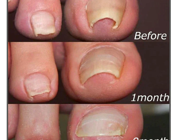 10+10 GRATIS | FixaNail - Sofortige Nagelreparatur